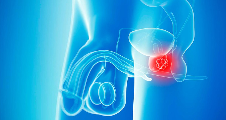 Cancerul de prostata - simptome, diagnostic, tratament